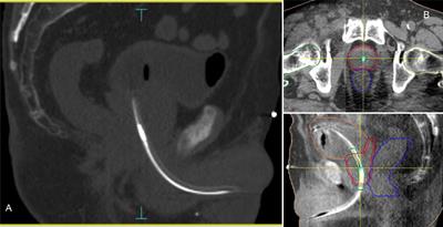 Intrafraction Prostate Motion Management During Dose-Escalated Linac-Based Stereotactic Body Radiation Therapy